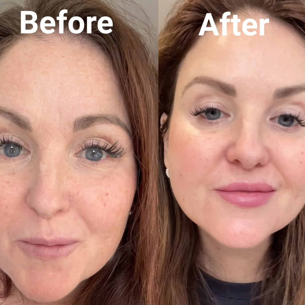 ULTRAISER HIFU Treatment Review: Impressive Results in Just 2 Months